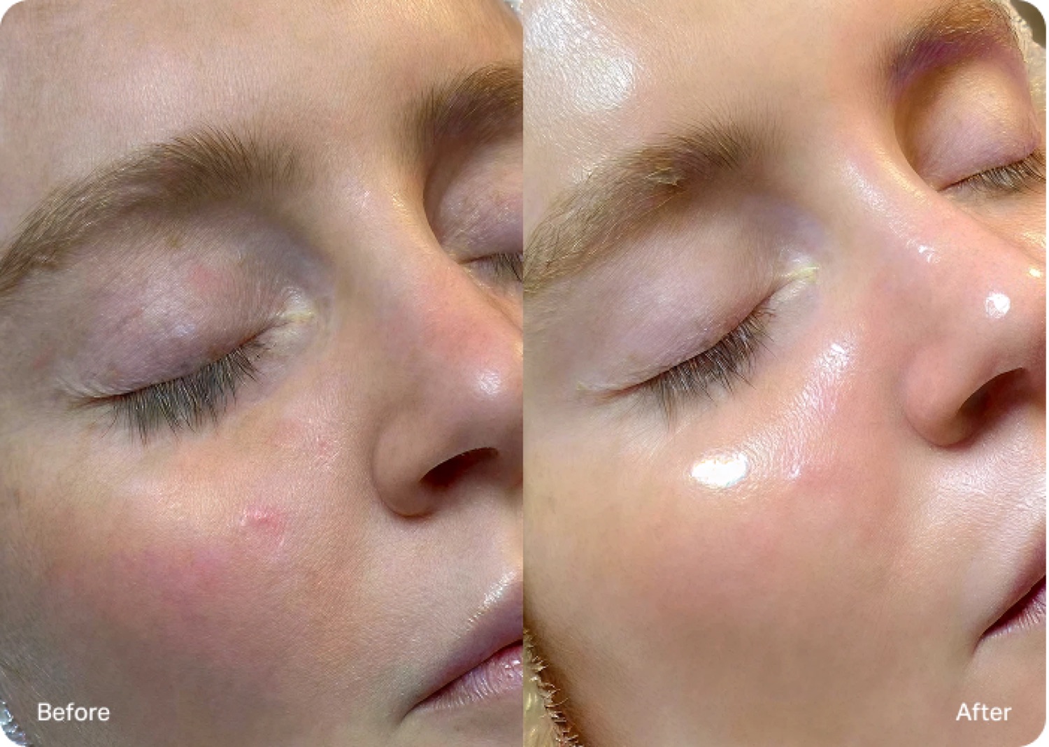 Before and after comparison of a client's skin following Hydrafacial treatment